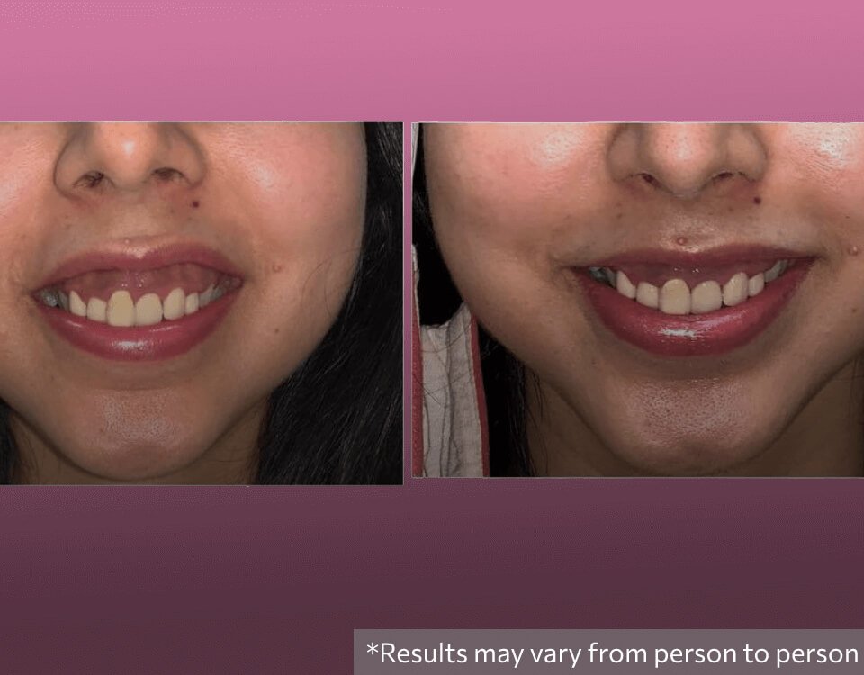 Gummy Smile Correction