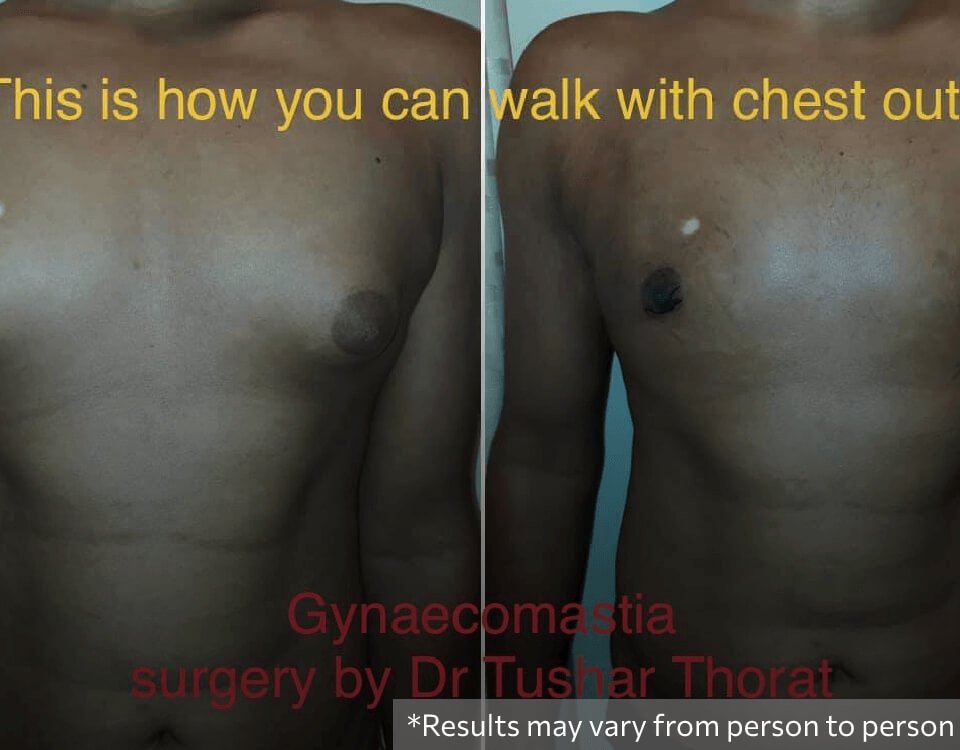 Gynecomastia Treatment