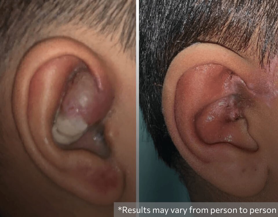 Hemangioma Treatment