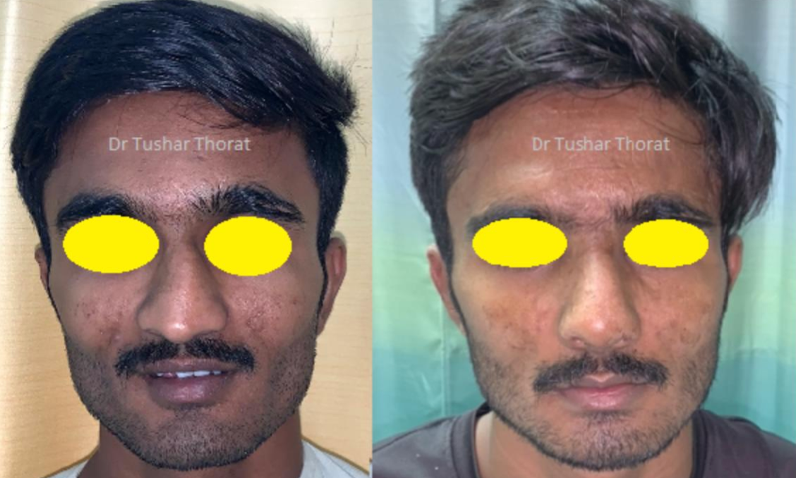 Rhinoplasty Surgery - Before After