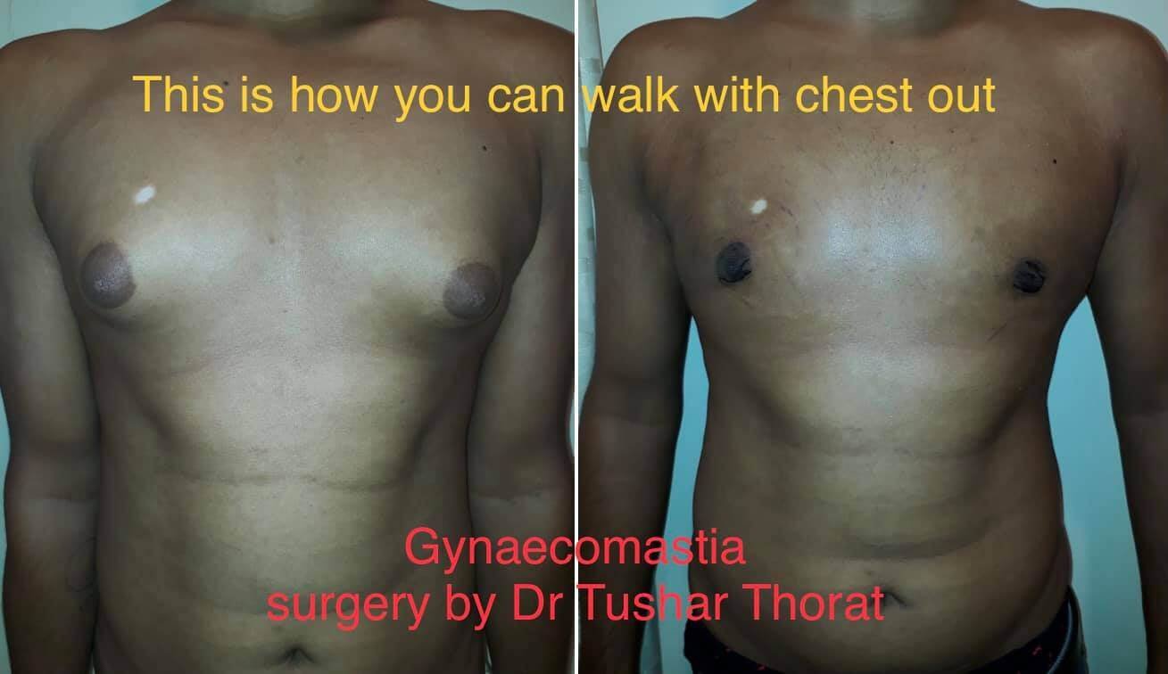 Gynecomastia surgery done by Dr. Tushar Thorat 
