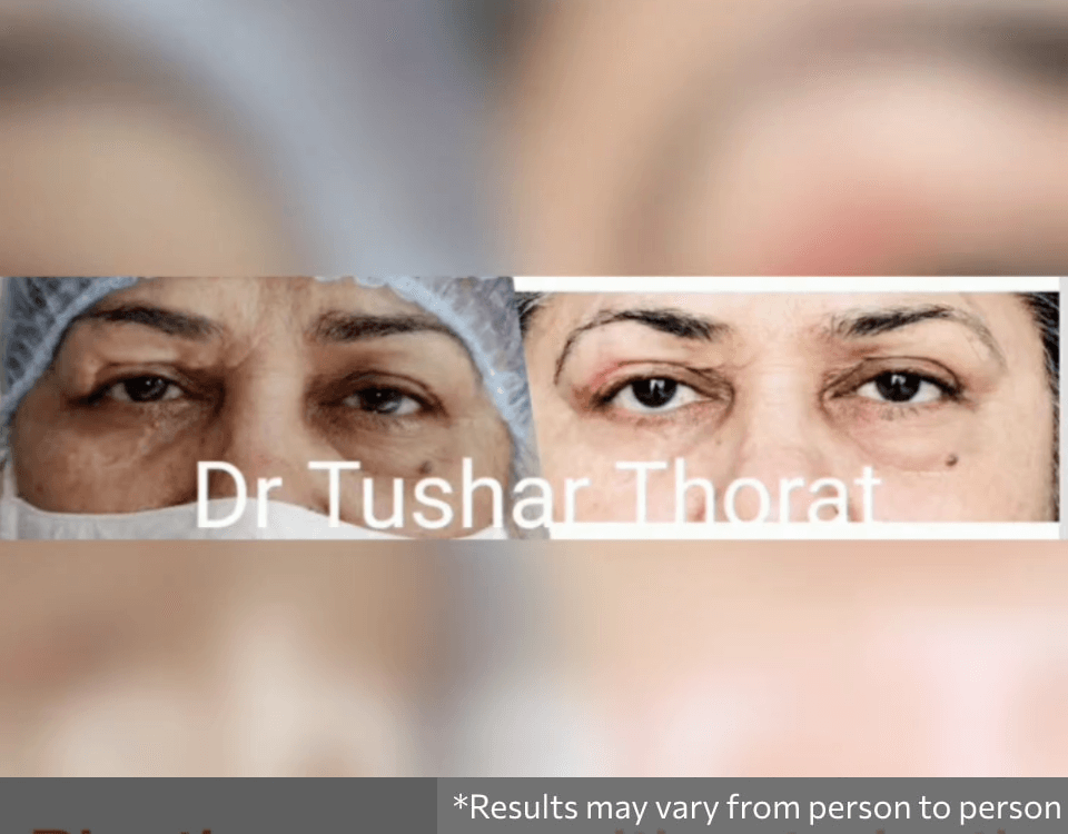 Eyelid Surgery