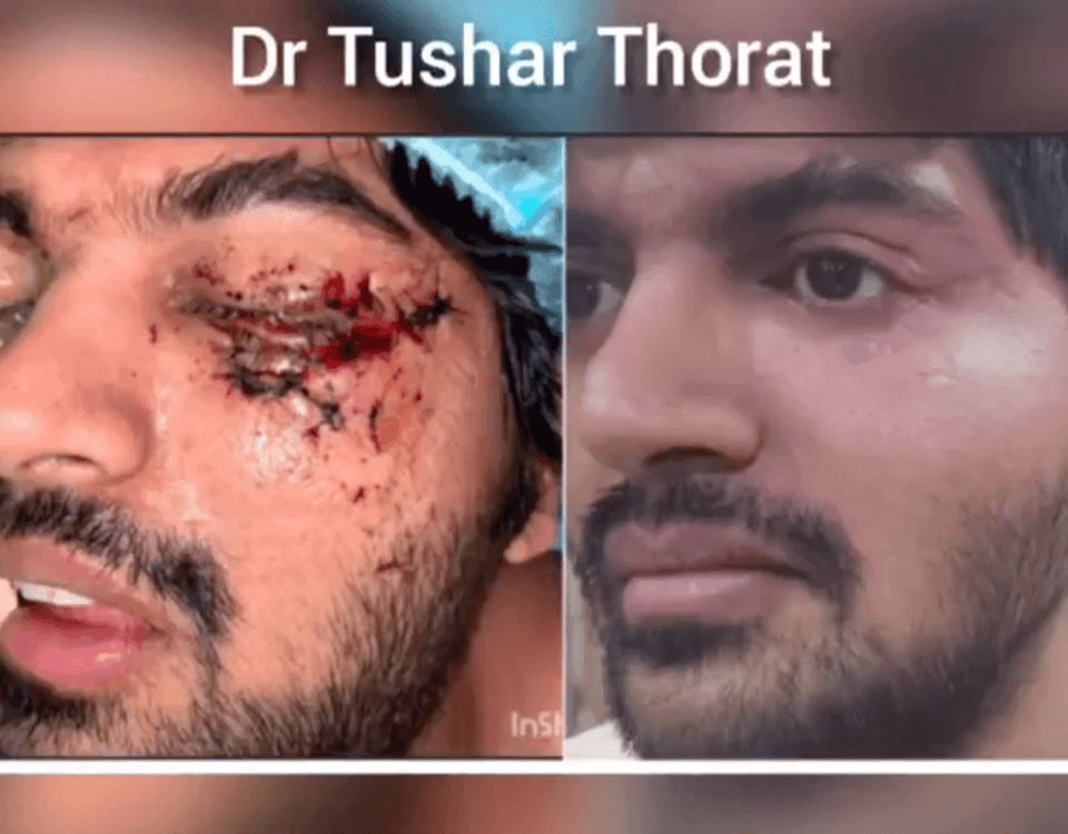 Facial Fractures Surgery in Mumbai