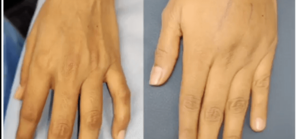 Hand rejuvenation surgery in Mumbai
