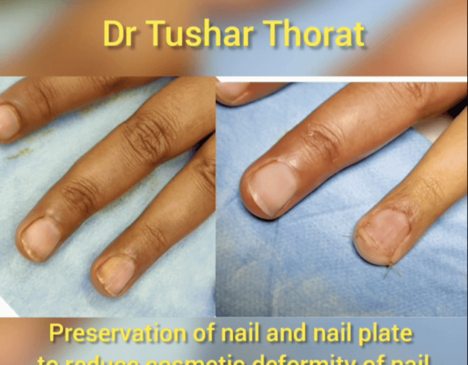 Nail Avulsion in Mumbai