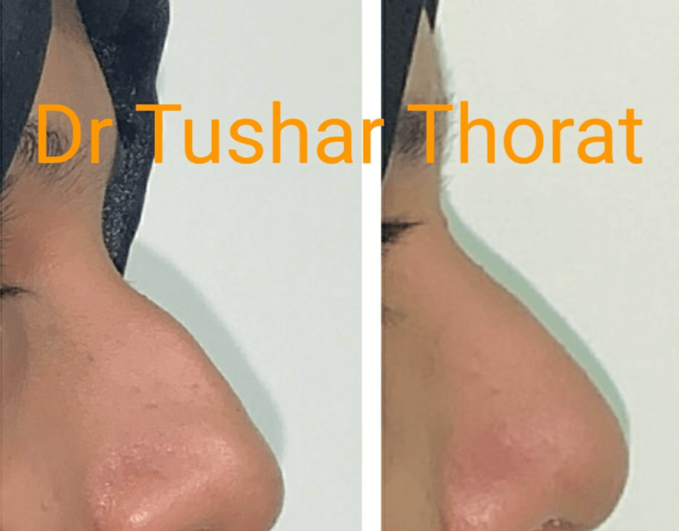 Rhinoplasty Surgeon in Mumbai