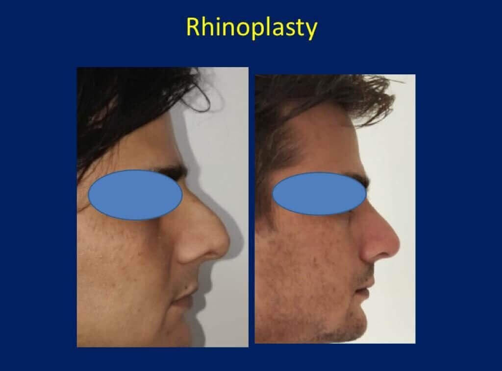 Nose Reshaping Surgery - Before After