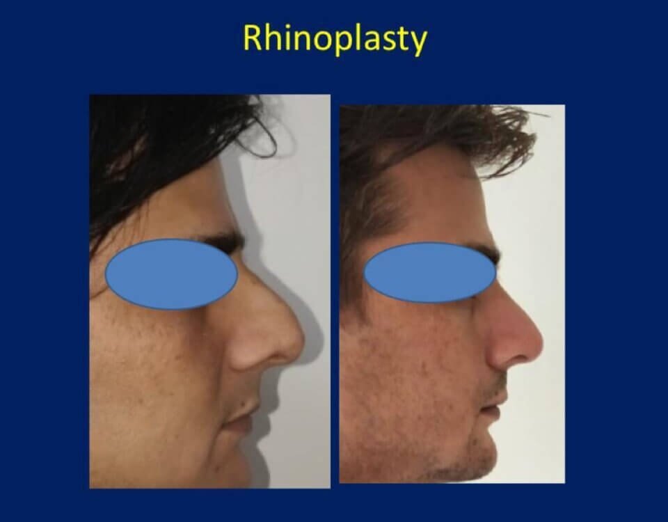 Rhinoplasty surgery in Mumbai