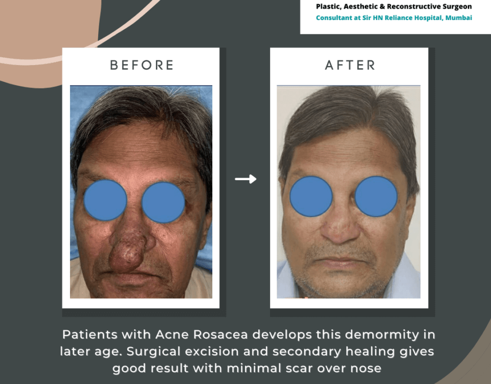 Nose Job Surgery in Mumbai