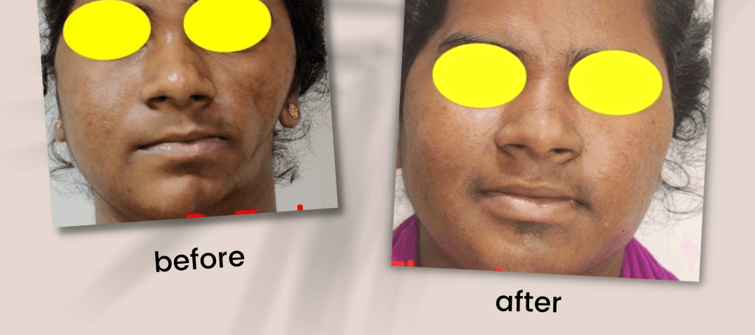 Face Deformity Surgery in Mumbai