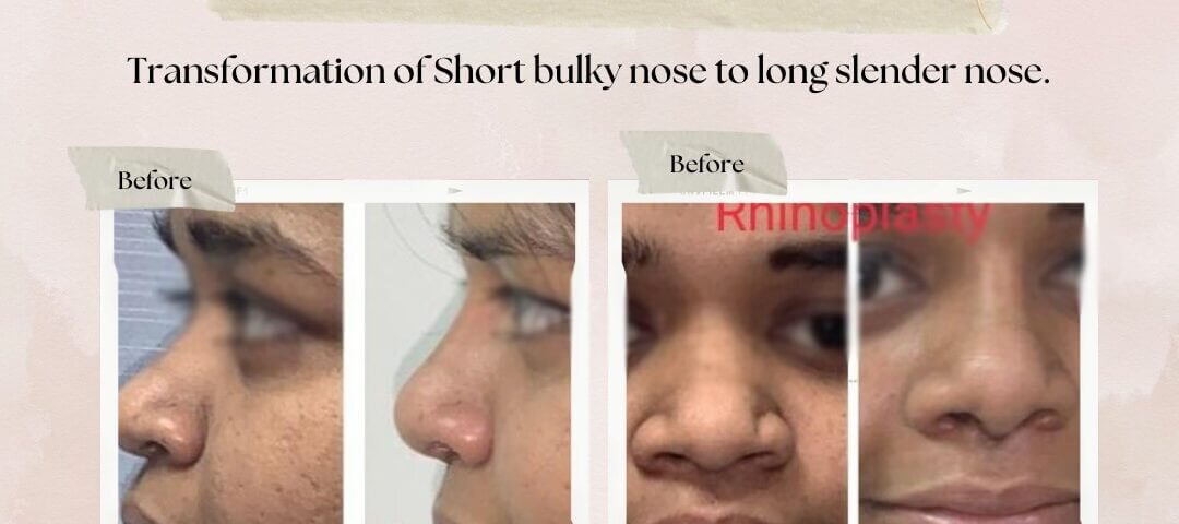 Rhinoplasty Surgery in Mumbai