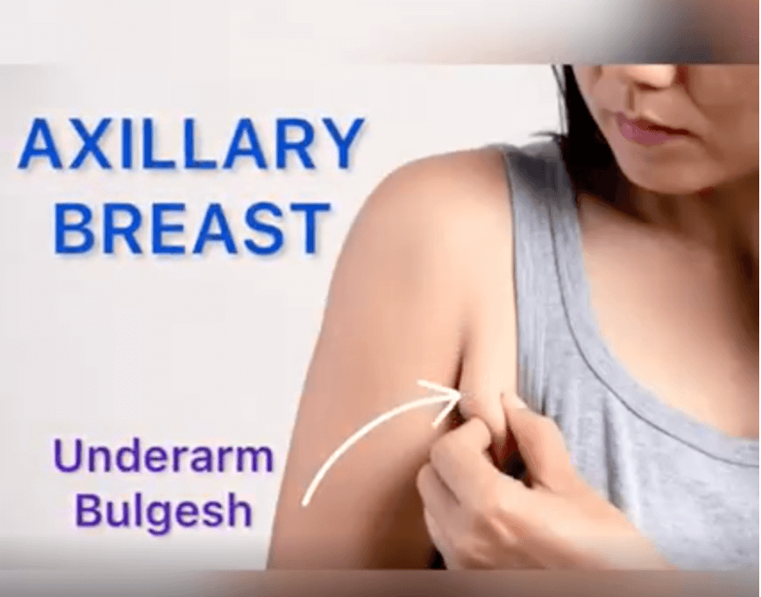 Axillary Breast Treatment in Mumbai