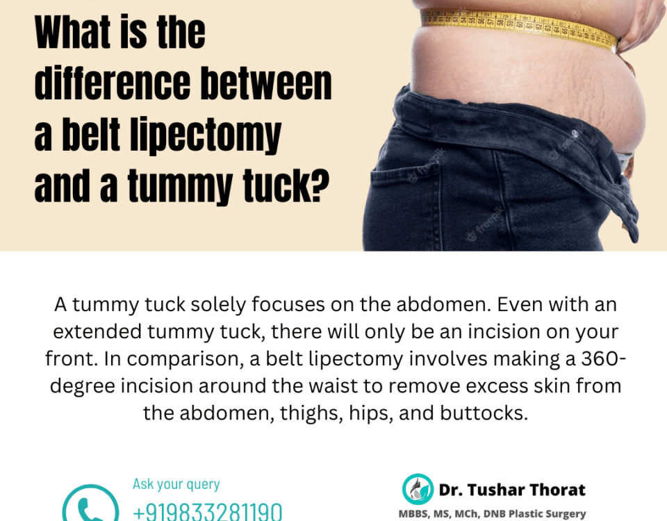 What is the difference between a belt lipectomy and a tummy tuck?