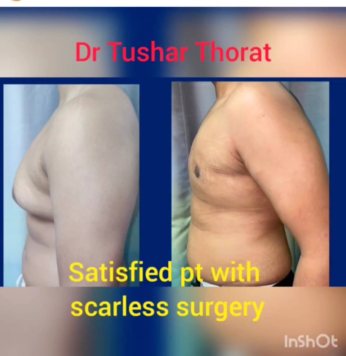 Gynecomastia Surgery Result by Plastic Surgeon Mumbai